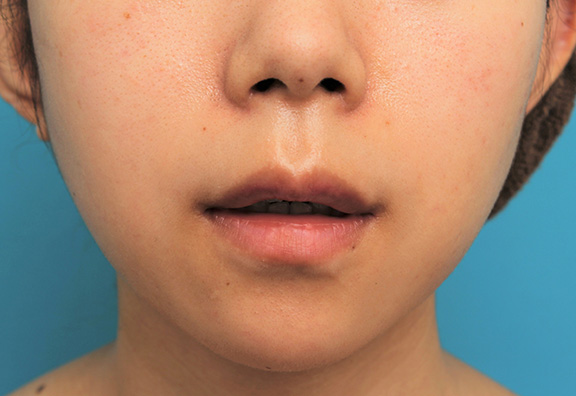 症例写真,上唇の真ん中の出っ張り（上唇結節）を手術で切除して目立たなくした症例写真,After（6ヶ月後）,ba_usuku014_b02.jpg