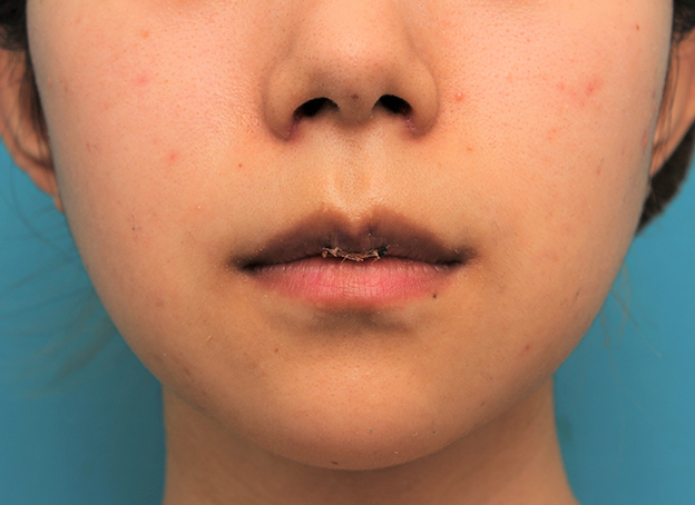 症例写真,上唇の真ん中の出っ張り（上唇結節）を手術で切除して目立たなくした症例写真,5日後,口を閉じた状態,mainpic_usuku014d.jpg
