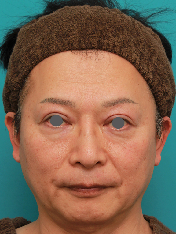 50代の男性の鼻にシリコンプロテーゼを入れて鼻筋を通した症例写真,After（2ヶ月後）,ba_ryubi1056_a01.jpg