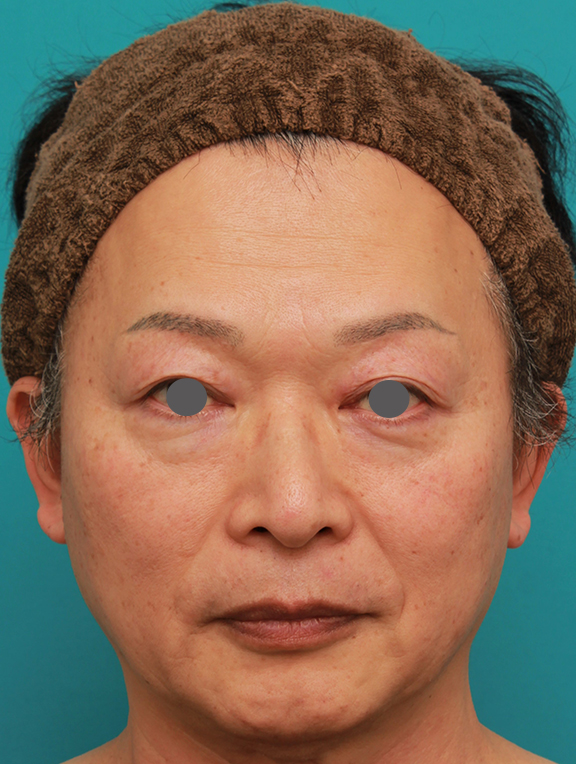 50代の男性の鼻にシリコンプロテーゼを入れて鼻筋を通した症例写真,Before,ba_ryubi1056_b01.jpg
