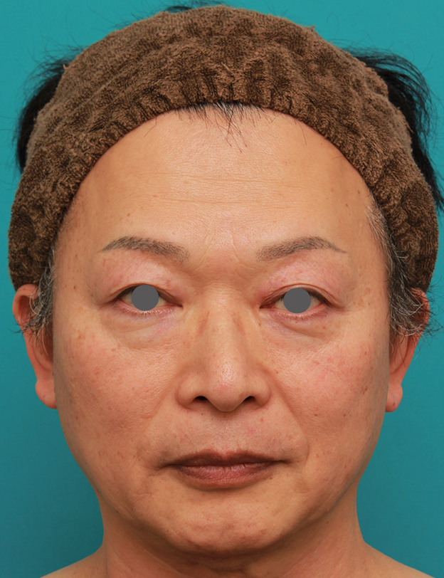 症例写真,50代の男性の鼻にシリコンプロテーゼを入れて鼻筋を通した症例写真,手術前,mainpic_ryubi1056a.jpg