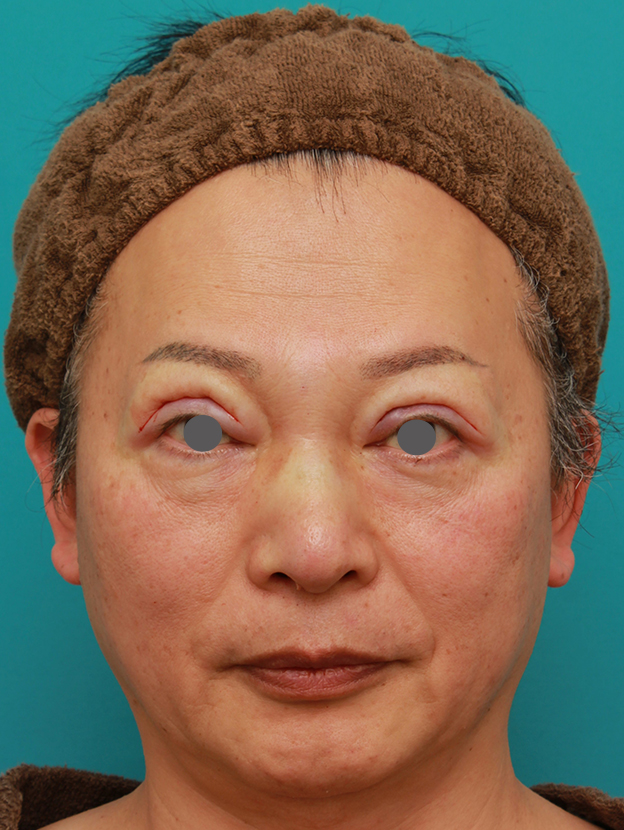 症例写真,50代の男性の鼻にシリコンプロテーゼを入れて鼻筋を通した症例写真,手術直後,mainpic_ryubi1056b.jpg