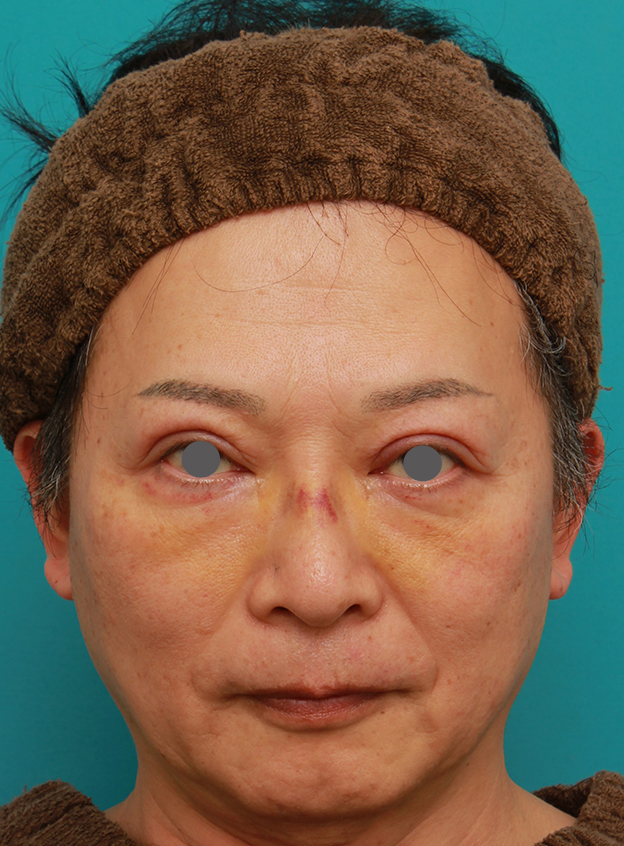 症例写真,50代の男性の鼻にシリコンプロテーゼを入れて鼻筋を通した症例写真,6日後,mainpic_ryubi1056c.jpg