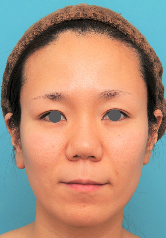 症例写真,バッカルファット除去手術を行った30代女性の症例写真,After（6ヶ月後）,ba_buccalfat020_b01.jpg