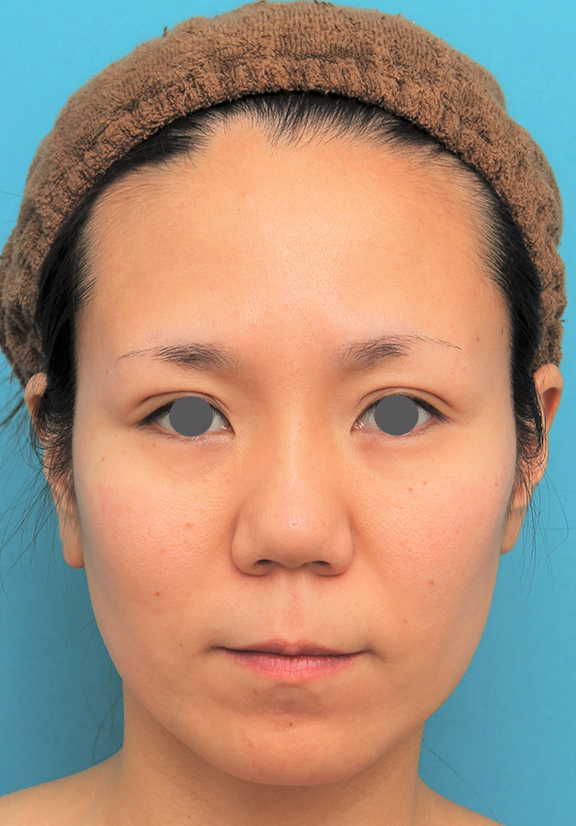 バッカルファット除去,バッカルファット除去手術を行った30代女性の症例写真,Before,ba_buccalfat020_b01.jpg