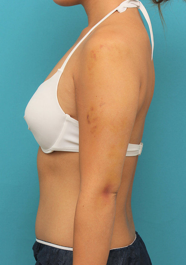 症例写真,20代女性の二の腕の脂肪吸引の症例写真,1週間後,mainpic_shibokyuin042c.jpg