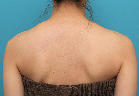 症例写真,発達した肩の筋肉にボツリヌストキシン注射をし、綺麗なシルエットにした20代女性の症例写真,Before,ba_beautiful_shoulder_botox006_b02.jpg
