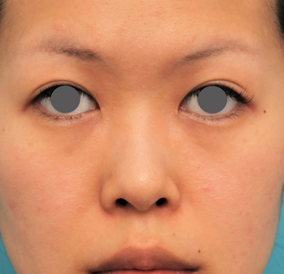 鼻にシリコンプロテーゼを入れ、自然な範囲内で鼻筋を通した症例写真,Before,ba_ryubi1057_b01.jpg
