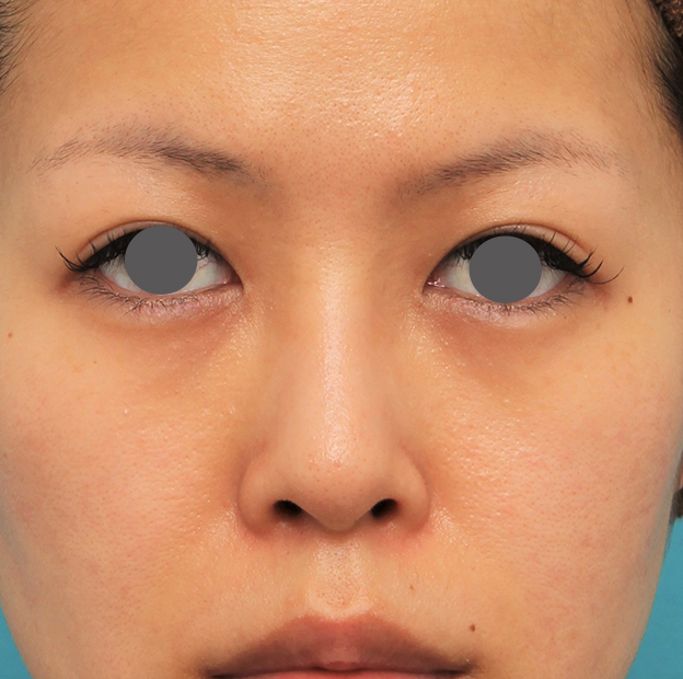 症例写真,鼻にシリコンプロテーゼを入れ、自然な範囲内で鼻筋を通した症例写真,3週間後,mainpic_ryubi1057d.jpg