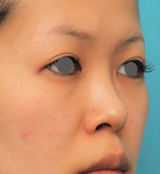 症例写真,鼻にシリコンプロテーゼを入れ、自然な範囲内で鼻筋を通した症例写真,手術前,mainpic_ryubi1057g.jpg