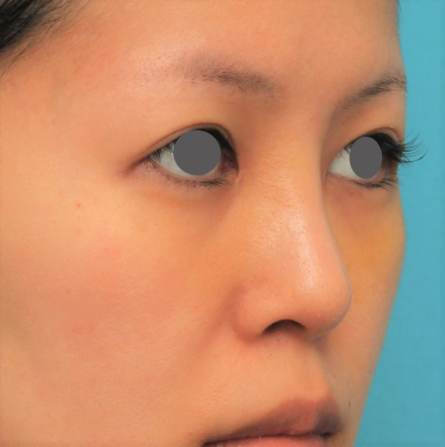 症例写真,鼻にシリコンプロテーゼを入れ、自然な範囲内で鼻筋を通した症例写真,1週間後,mainpic_ryubi1057i.jpg