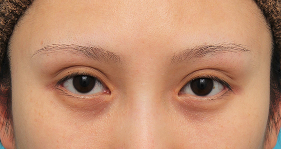 症例写真,目頭切開+目尻切開で目の横幅を広げた症例写真,After（6ヶ月後）,ba_megashira061_b01.jpg