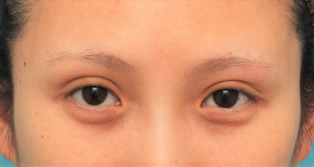 症例写真,目頭切開+目尻切開で目の横幅を広げた症例写真,手術前,mainpic_megashira061a.jpg