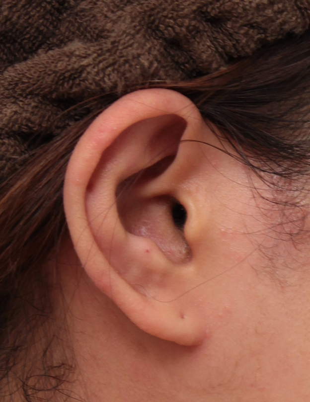 症例写真,耳介軟骨移植でガミースマイルを永久的に治した症例写真,1週間後,mainpic_gammy_005j.jpg