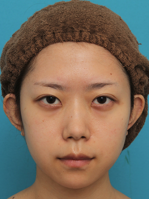 症例写真,引っ込んでいる顎をシリコンプロテーゼで前方に出した20代女性の症例写真,After（6ヶ月後）,ba_ago020_b01.jpg