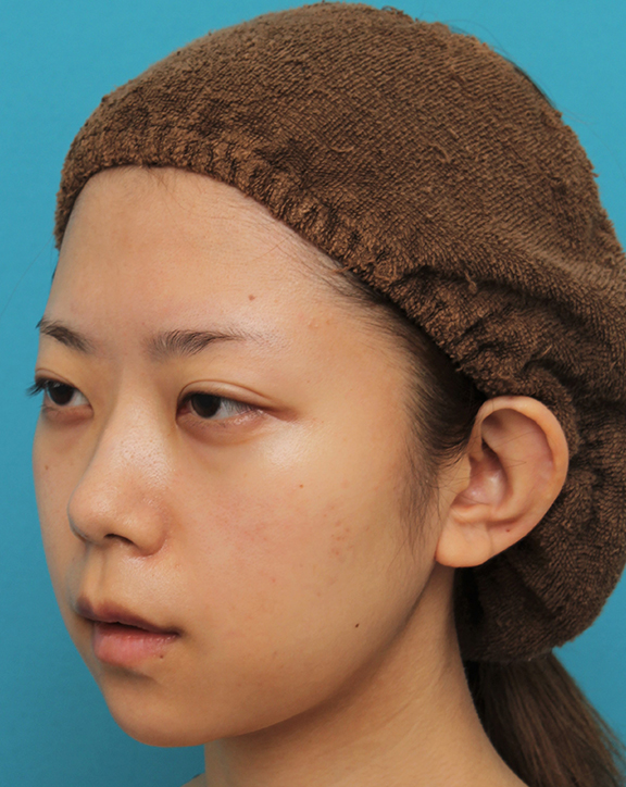 症例写真,引っ込んでいる顎をシリコンプロテーゼで前方に出した20代女性の症例写真,After(6ヶ月後),ba_ago020_b02.jpg