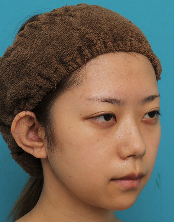 症例写真,引っ込んでいる顎をシリコンプロテーゼで前方に出した20代女性の症例写真,After(6ヶ月後),ba_ago020_b04.jpg