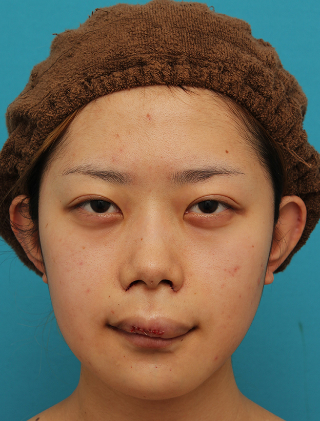 症例写真,引っ込んでいる顎をシリコンプロテーゼで前方に出した20代女性の症例写真,手術直後,mainpic_ago020b.jpg