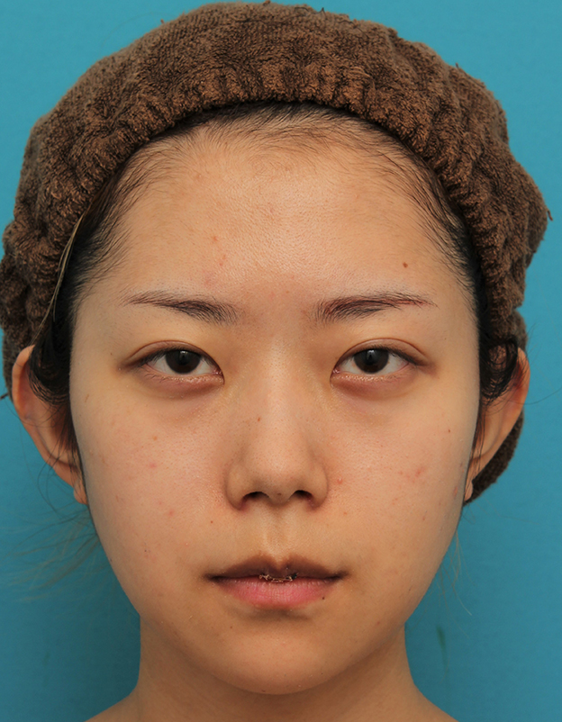症例写真,引っ込んでいる顎をシリコンプロテーゼで前方に出した20代女性の症例写真,1週間後,mainpic_ago020c.jpg
