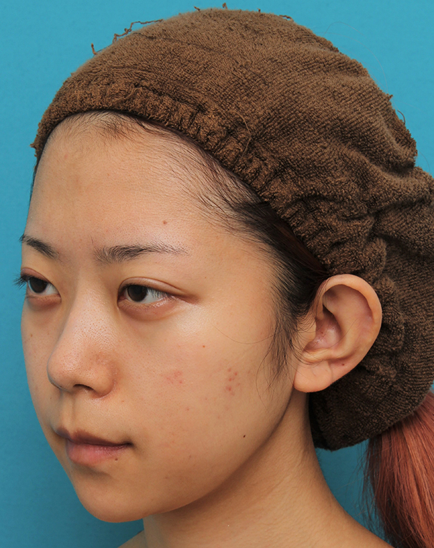 症例写真,引っ込んでいる顎をシリコンプロテーゼで前方に出した20代女性の症例写真,2ヶ月後,mainpic_ago020m.jpg