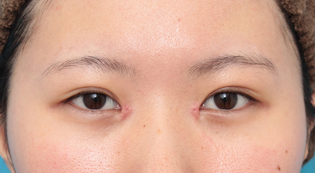 症例写真,他院で切りすぎてしまった目頭切開を蒙古襞形成で修正手術した症例写真,6日後,mainpic_hida010c.jpg