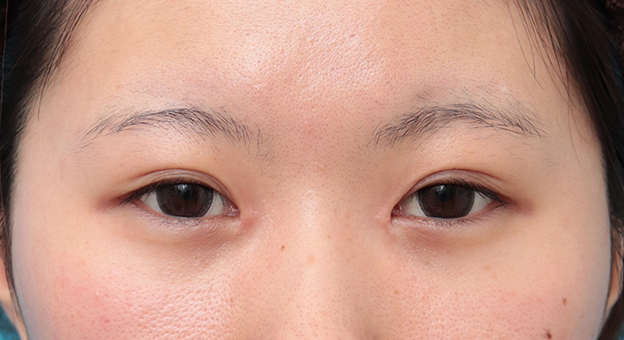 症例写真,他院で切りすぎてしまった目頭切開を蒙古襞形成で修正手術した症例写真,3週間後,mainpic_hida010d.jpg