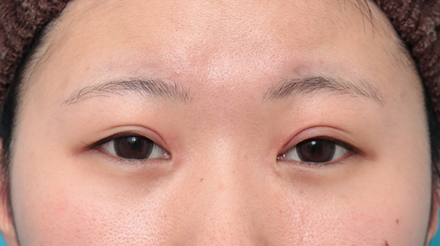 症例写真,他院で切りすぎてしまった目頭切開を蒙古襞形成で修正手術した症例写真,2ヶ月後,mainpic_hida010e.jpg