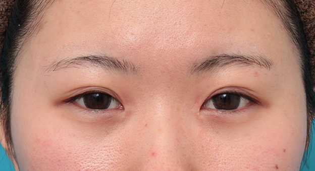 症例写真,他院で切りすぎてしまった目頭切開を蒙古襞形成で修正手術した症例写真,6ヶ月後,mainpic_hida010f.jpg