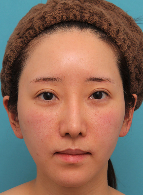メソシェイプフェイス（顔専用脂肪溶解注射）で小顔になった症例写真,After（7回目注射後）,ba_meso_face016_a01.jpg
