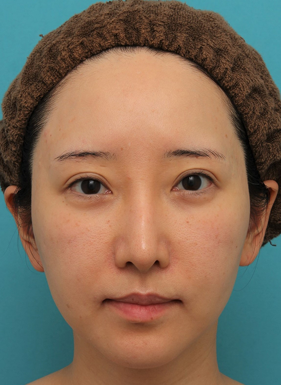 メソシェイプフェイス（顔専用脂肪溶解注射）で小顔になった症例写真,Before,ba_meso_face016_b01.jpg