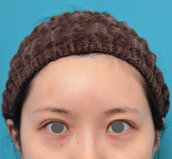 症例写真,ヒアルロン酸注射で額を丸く出した20代女性の症例写真,After(翌日),ba_hitai_hyaluron007_b03.jpg