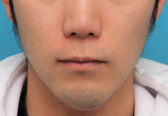 症例写真,手術で薄めの唇にした症例写真,After（6ヶ月後）,ba_usuku015_b01.jpg