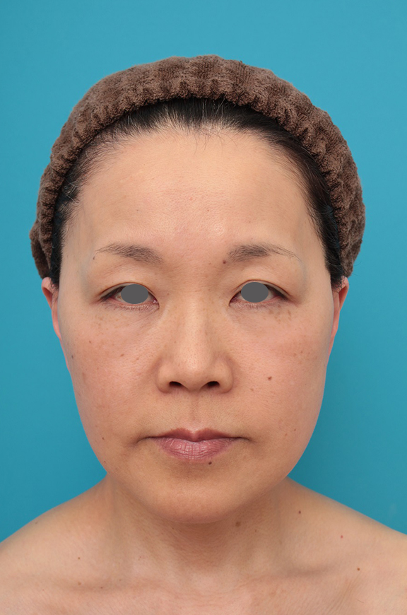 ミニフェイスリフト（頬のたるみ取り）,ミニフェイスリフト（頬のたるみ取り）の症例写真,After（1ヶ月後）,ba_minilift008_a01.jpg