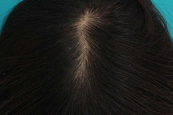 HARG治療（女性の薄毛治療）の症例写真,After（4ヶ月後）,ba_aga_josei002_a01.jpg