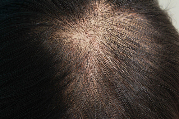 HARG治療（女性の薄毛治療）の症例写真,Before,ba_aga_josei002_b01.jpg