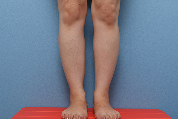 ふくらはぎボツリヌストキシン注射の症例写真,After（3ヶ月後）,ba_leg012_a01.jpg
