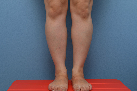 ボツリヌストキシン注射（ふくらはぎ・足やせ・美脚）,ふくらはぎボツリヌストキシン注射の症例写真,Before,ba_leg012_b01.jpg