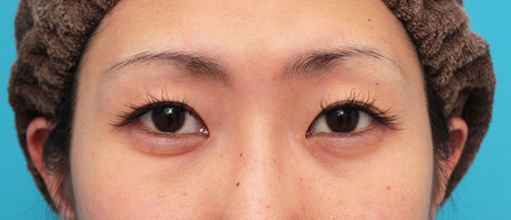 症例写真,上まぶたたるみとり・目尻切開・垂れ目形成の症例写真,Before,ba_tarumi015_b01.jpg
