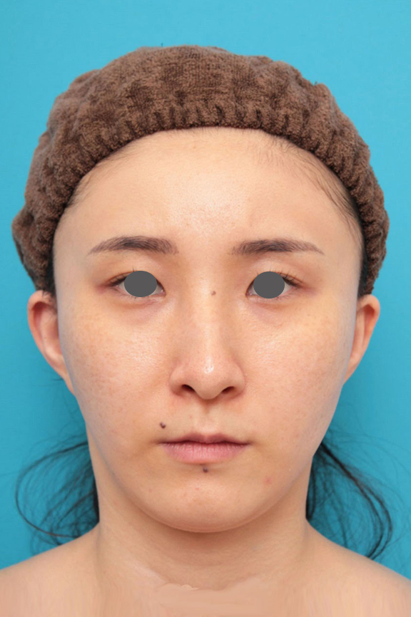 ミニフェイスリフト（頬のたるみ取り）・脂肪吸引（頬、あご下）の症例写真,After（6ヶ月後）,ba_minilift009_a01.jpg
