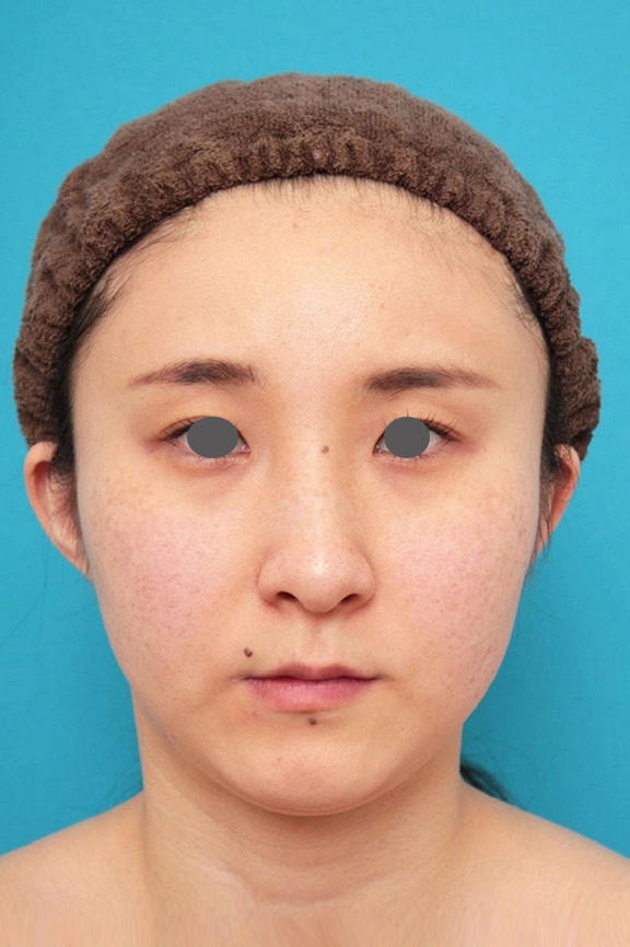 ミニフェイスリフト（頬のたるみ取り）・脂肪吸引（頬、あご下）の症例写真,Before,ba_minilift009_b01.jpg