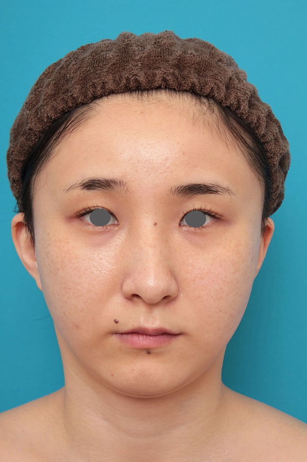 症例写真,ミニフェイスリフト（頬のたるみ取り）・脂肪吸引（頬、あご）の症例写真,1ヶ月後,mainpic_minilift009c.jpg
