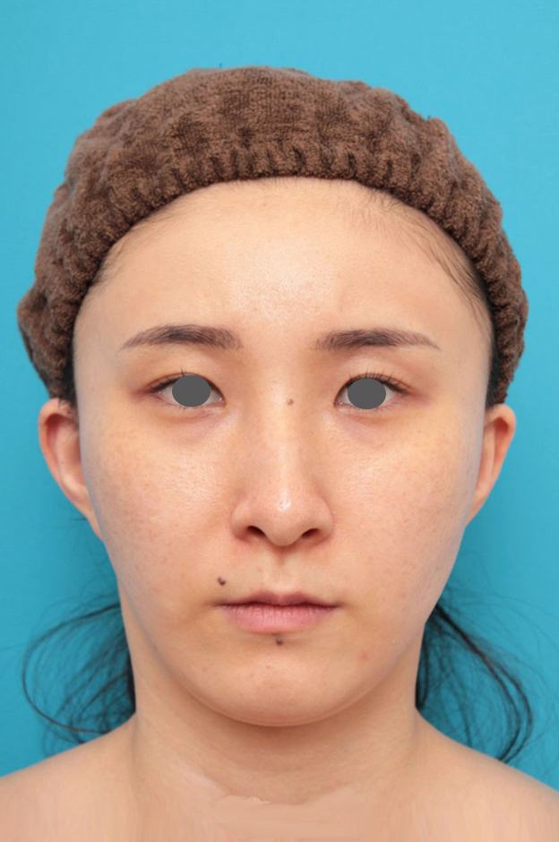 症例写真,ミニフェイスリフト（頬のたるみ取り）・脂肪吸引（頬、あご下）の症例写真,6ヶ月後,mainpic_minilift009d.jpg