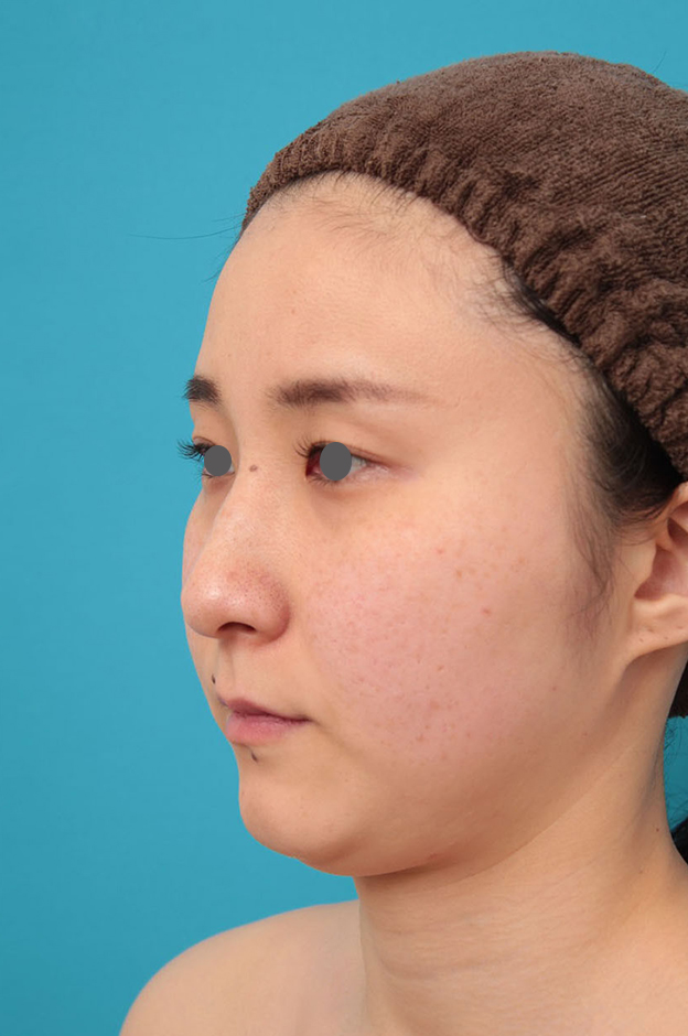 症例写真,ミニフェイスリフト（頬のたるみ取り）・脂肪吸引（頬、あご下）の症例写真,施術前,mainpic_minilift009e.jpg