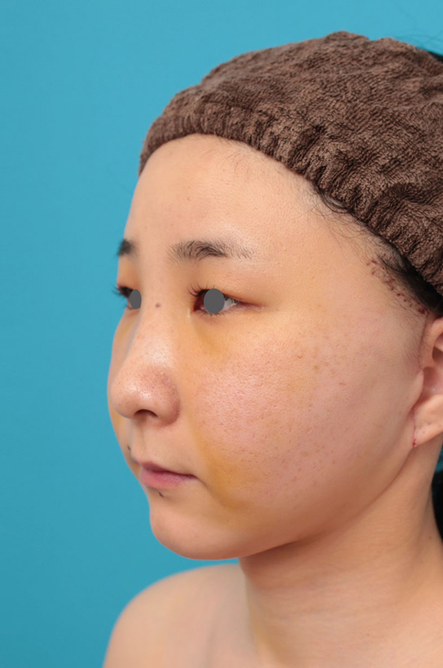 症例写真,ミニフェイスリフト（頬のたるみ取り）・脂肪吸引（頬、あご下）の症例写真,1週間後,mainpic_minilift009f.jpg