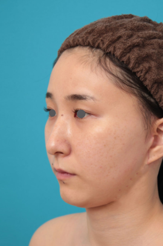 症例写真,ミニフェイスリフト（頬のたるみ取り）・脂肪吸引（頬、あご下）の症例写真,1ヶ月後,mainpic_minilift009g.jpg