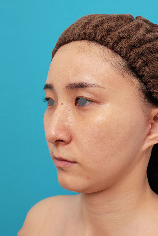 症例写真,ミニフェイスリフト（頬のたるみ取り）・脂肪吸引（頬、あご下）の症例写真,6ヶ月後,mainpic_minilift009h.jpg