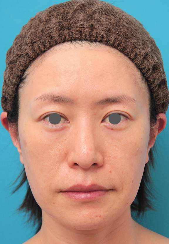 症例写真,40代後半女性のミディアムフェイスリフトの症例写真,Before,ba_mediumlift011_b01.jpg