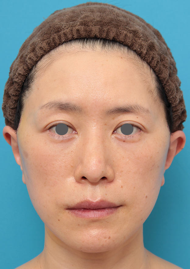 症例写真,40代後半女性のミディアムフェイスリフトの症例写真,6日後,mainpic_mediumlift011c.jpg