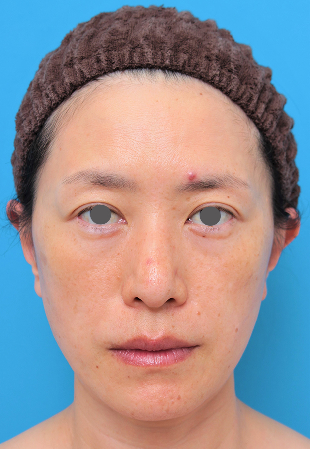 症例写真,40代後半女性のミディアムフェイスリフトの症例写真,6ヶ月後,mainpic_mediumlift011d.jpg