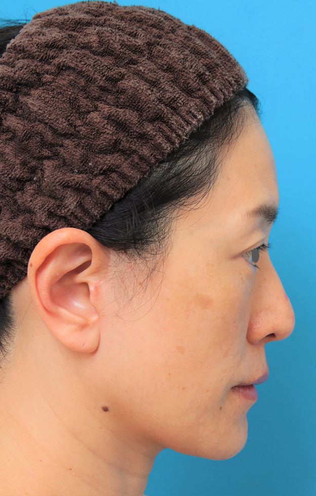 症例写真,40代後半女性のミディアムフェイスリフトの症例写真,6ヶ月後,mainpic_mediumlift011h.jpg